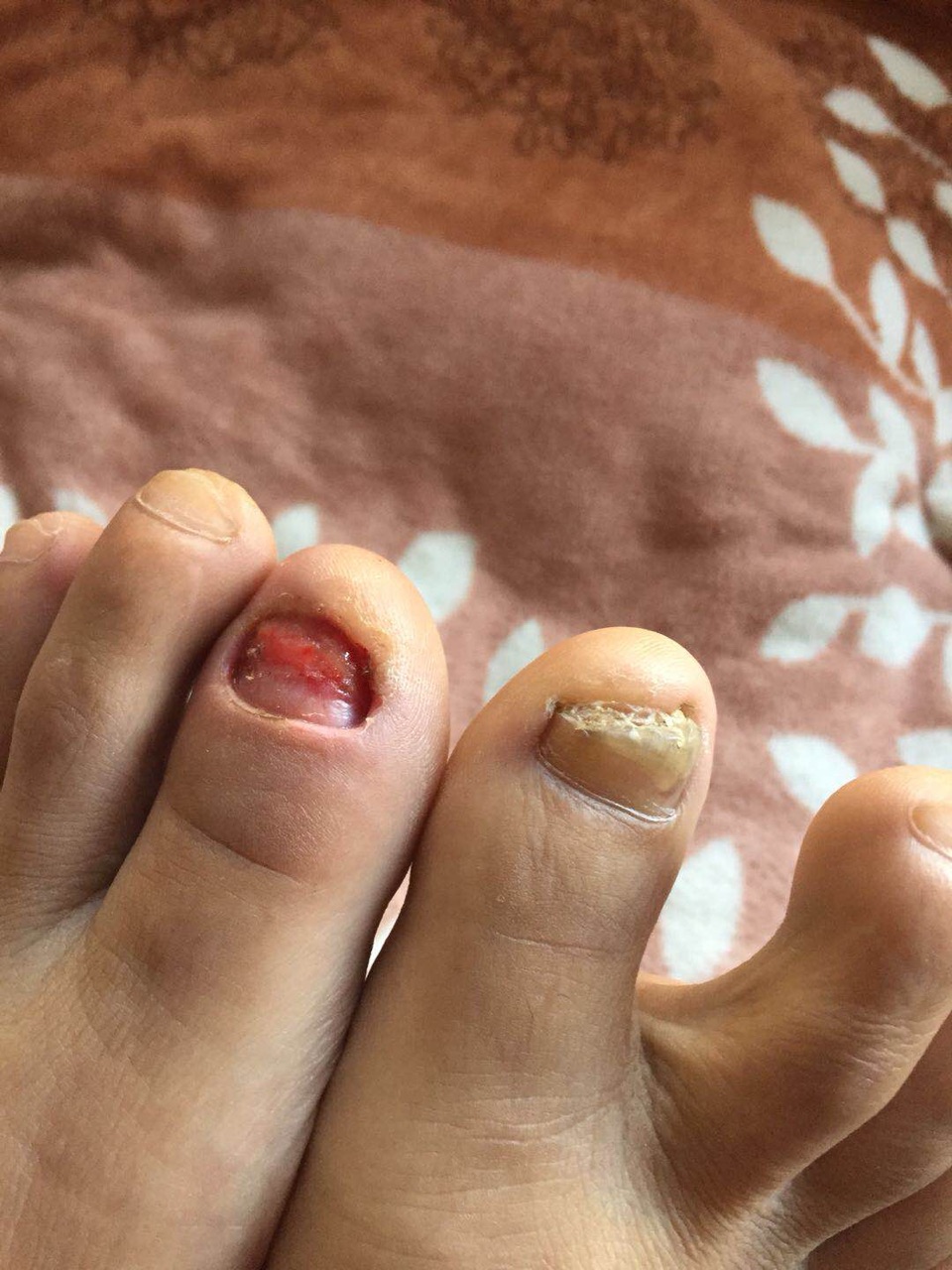 脚指受伤了,脚上指甲还能长出吗